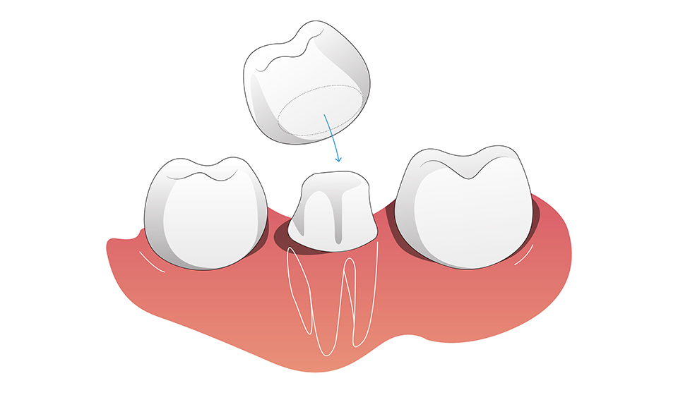 5 Common Dental Problems that Dental Crowns Can Resolve