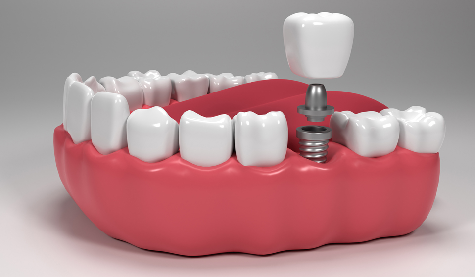 Smile Transformation in a Single Day: The Advantages of Same-Day Implants