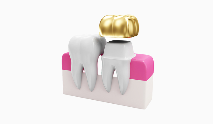 A Beginner’s Guide to Dental Crowns: Process & Care