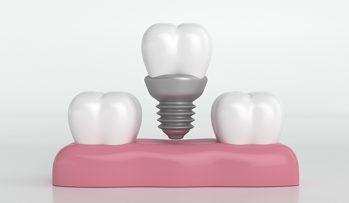 How do Dental Implants Work and What are Their Benefits?