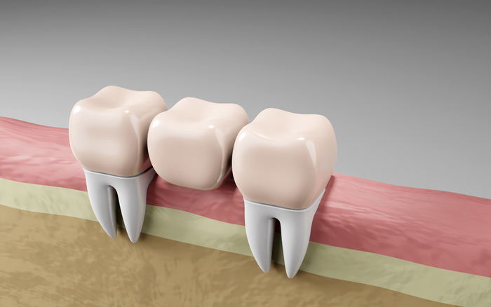 Why Dental Bridges Are a Game-Changer for Missing Teeth