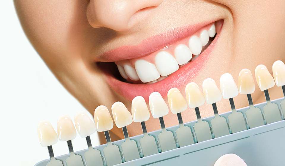 Dental veneers